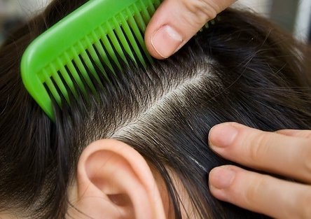 Свежие новости: 9-летняя девочка умерла после мытья головы средством против вшей