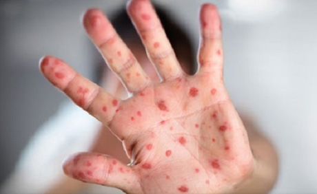 Свежие новости: Заболеваемость корью продолжает расти - Минздрав