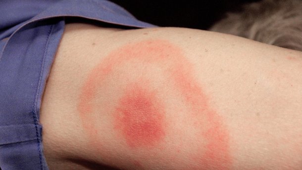 Фото новости: Болезнь Лайма. В Украине растет количество больных Свежие новости: Болезнь Лайма. В Украине растет количество больных