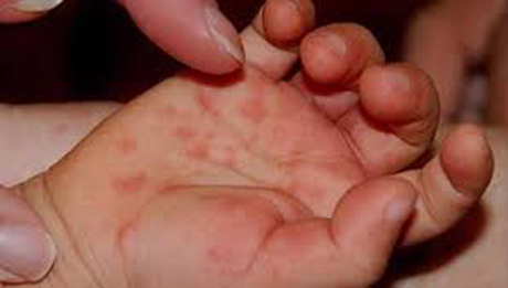 Свежие новости: Украина заняла первое место в Европе по числу заболевших корью