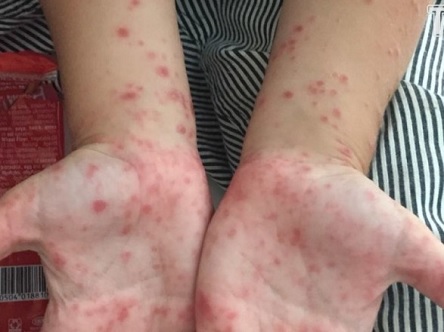 Свежие новости: ВІДЕО: Вісім класів одеських шкіл закриті на карантин через небезпечне захворювання