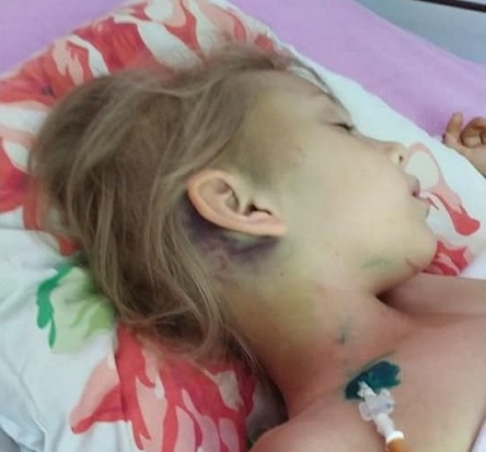 Свежие новости: Николаевцев просят помочь девочке, которая упала с 3-хметровой высоты и сломала шею