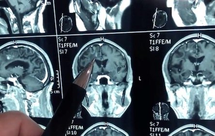 Свежие новости: В мозгу китайца 30 лет жил огромный червь. ВИДЕО