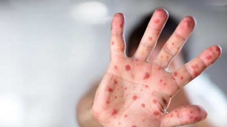 Свежие новости: Корь в Киеве: зафиксировано 200 случаев заболевания