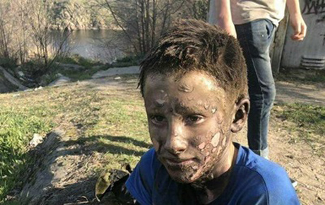 Свежие новости: В Запорожье ребенок выжил после удара током в 10 тысяч вольт