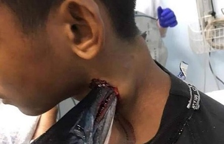 Свежие новости: Рыба выпрыгнула из воды и проткнула рыбаку шею