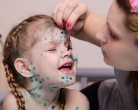 Свежие новости: В Київський області новий спалах захворювання на кір і вітрянку