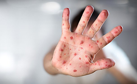 Свежие новости: В николаевской школе-интернате еще три ребенка заболели корью