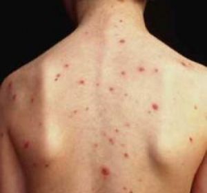 Свежие новости: В Запорожье зафиксировали вспышку кори