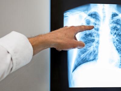 Свежие новости: Одесская область сохраняет лидерство по заболеваемости туберкулезом