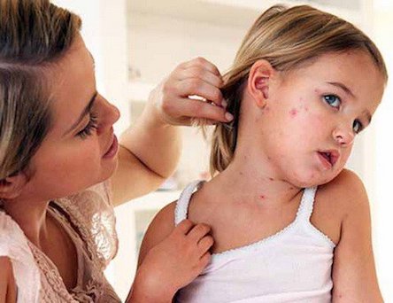 Свежие новости: Уровень заболеваемости корью в Украине не падает, но ситуация стабилизировалась, – Минздрав