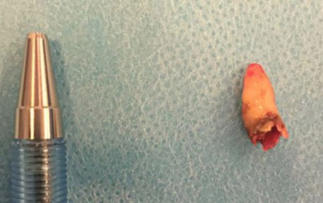 Свежие новости: У жителя Дании в носу вырос зуб