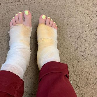 Свежие новости: Жительница Николаева получила химические ожоги после процедуры педикюра