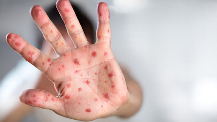 Свежие новости: В Украине корь поразила 200 человек