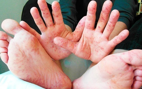 Свежие новости: С начала года корью заболели почти 50 тысяч человек