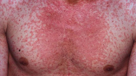 Свежие новости: В Николаеве с корью госпитализированы 16 морских пехотинцев