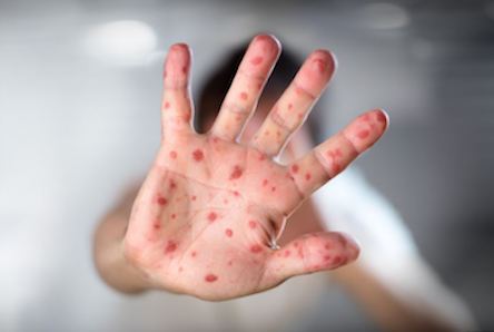 Свежие новости: За неделю корью в Украине заболел 261 человек