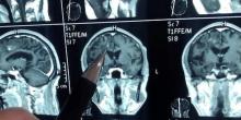 Свежие новости: В мозгу китайца 30 лет жил огромный червь. ВИДЕО