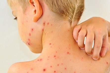 Свежие новости: Вспышка кори: в Киеве за пять дней уже заболело более 10 человек