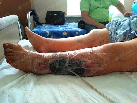 Свежие новости: Подробности мощного взрыва в киевской маршрутке: ногу пожилой женщины разорвало до кости (ФОТО 18+)