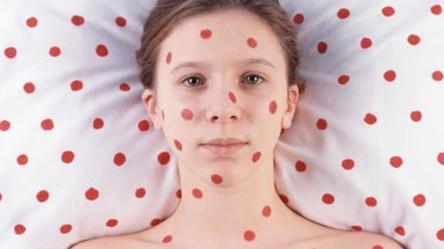 Свежие новости: В Одессе ежедневно в «инфекционку» поступают 12-16 больных корью